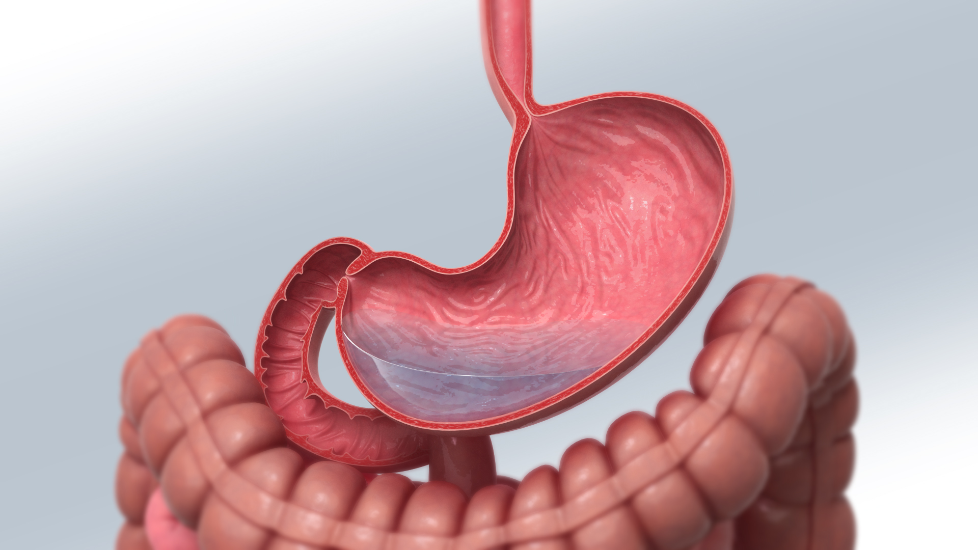 Cirurgia bariátrica disabsortiva