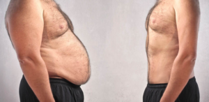 Requisitos para realização da cirurgia bariátrica