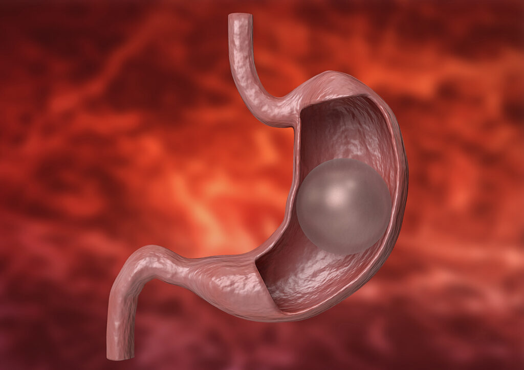 Cirurgia bariátrica e balão gástrico