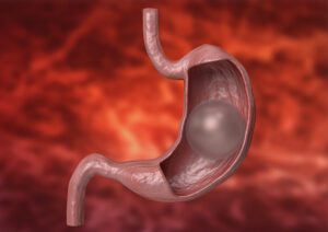 Cirurgia bariátrica e balão gástrico